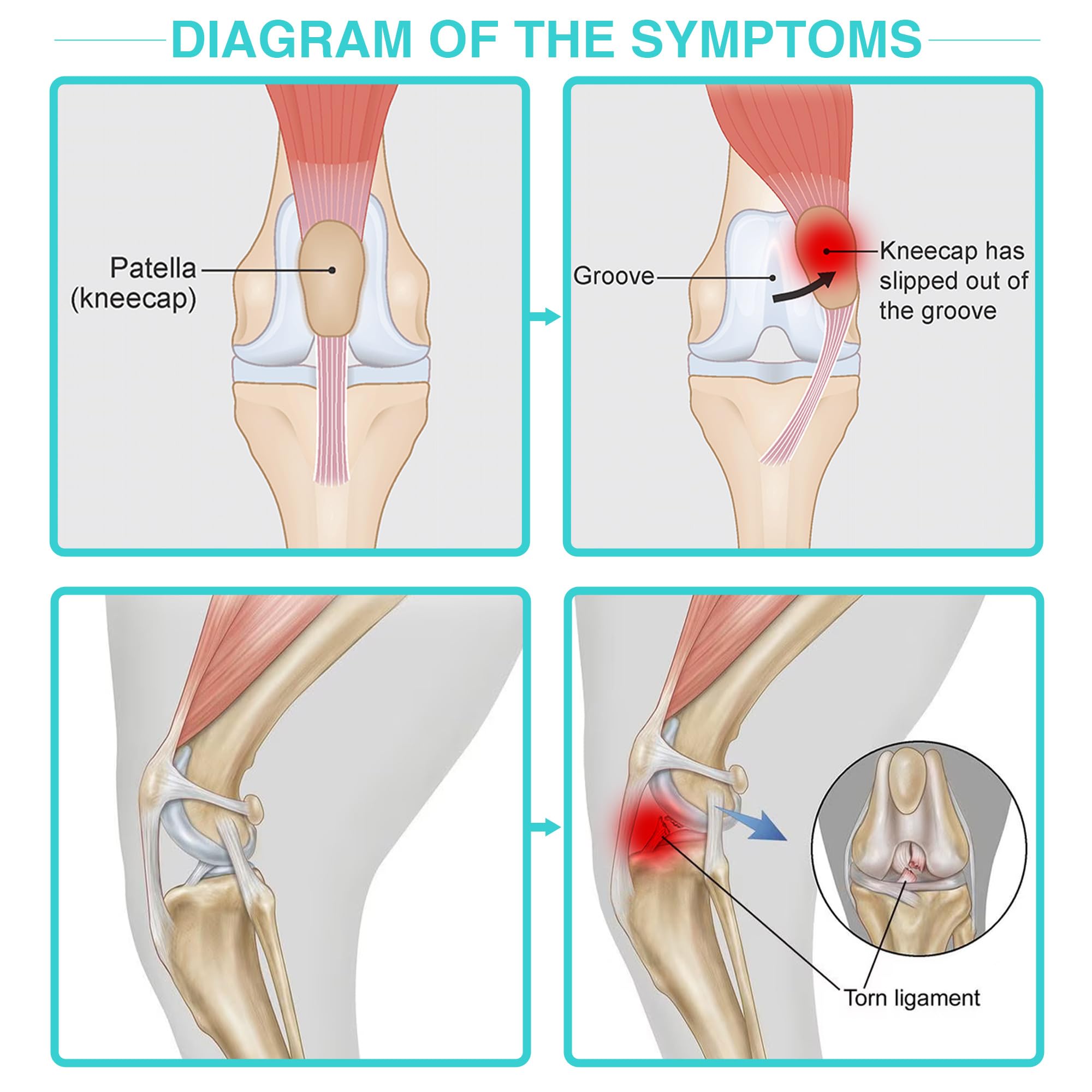 Dog Luxating Patella Knee Brace With Hanress